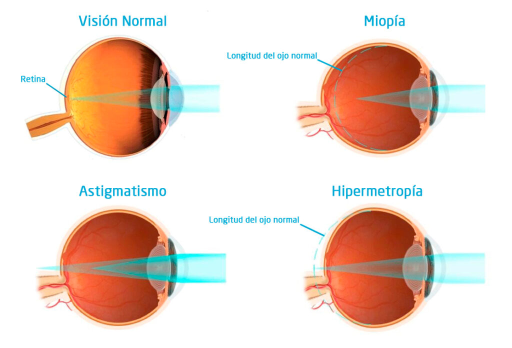 Defectos refractivos