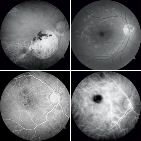 Resultado Angiografia